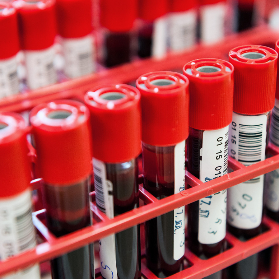 <p>Testē&scaron;anas nedēļā dažiem RAKUS apmeklētājiem atklāts C hepatīts</p>